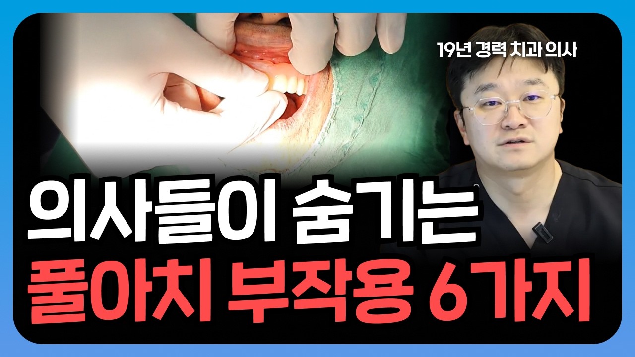 풀아치 임플란트 단점? 이런 분들은 하지 마세요