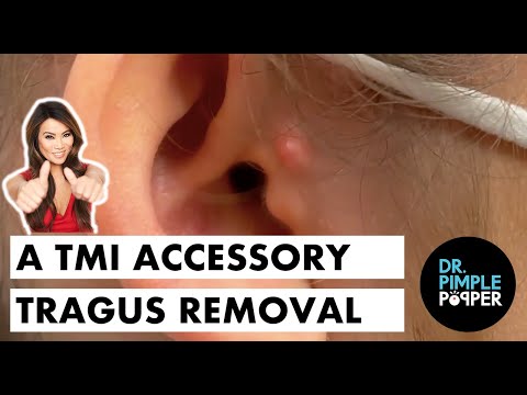 A TMI Accessory Tragus Removal - A TMI Accessory Tragus Removal