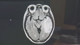 Study: Lasting impact of COVID-19 can lead to crushing fatigue, severe headaches