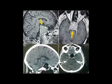 Эндоскопическое удаление опухолей гипофиза эндоназальным доступом