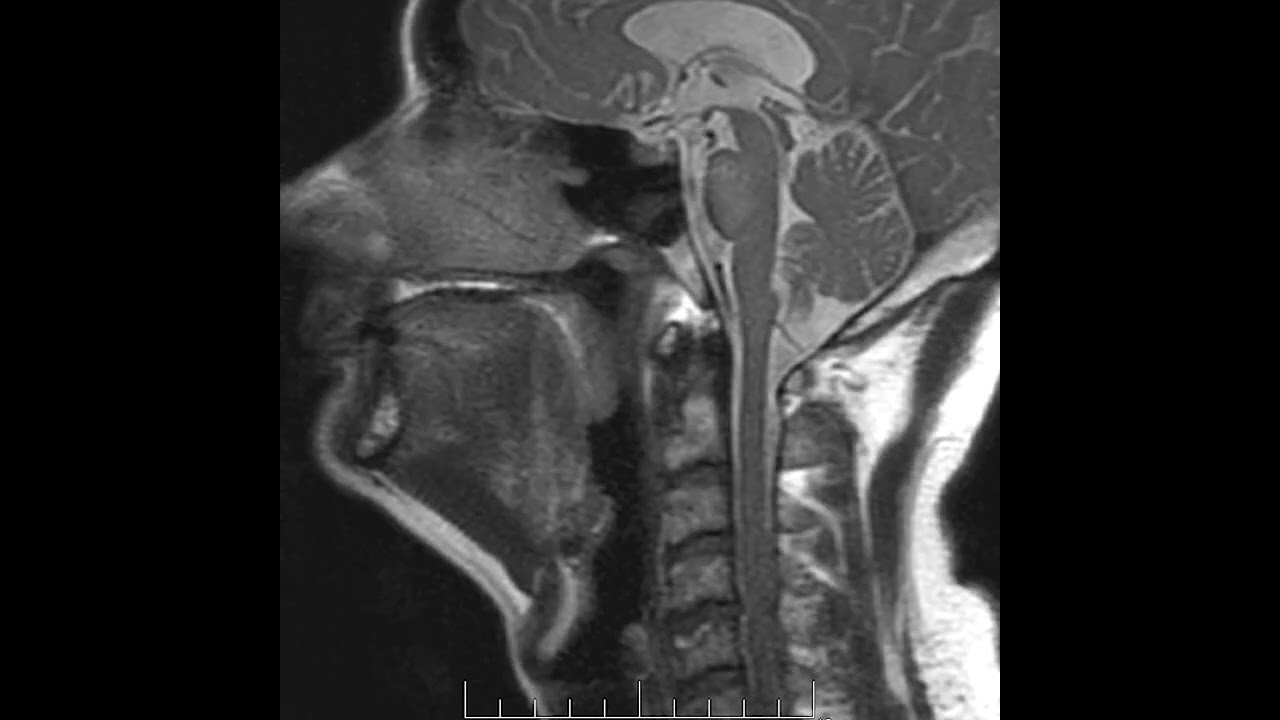 Upper airway dynamic magnetic resonance in sleep apnea – Video S4 [530742]