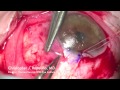 Pterygium Excision with a Conjunctival Auto Graft using Fibrin Glue