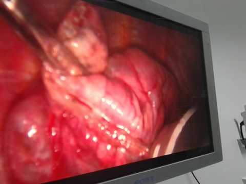Video: Bullectomie: Informatie Over Chirurgie En Herstel