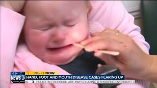 Dr. Mehra talks about hand, foot and mouth disease