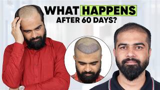 Hair Transplant in Jabalpur (HX-TTEQ) | Best Results & Cost of Hair Transplant in Jabalpur