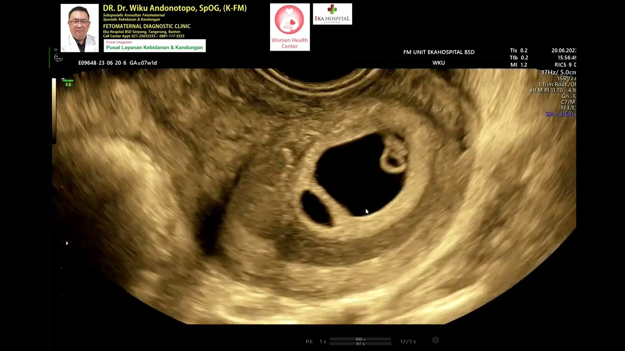 Kembar 6 minggu dgn salah satu GS kosong blighted ovum