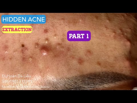 Mụn trứng cá mặt cực nặng|Dermatologist,pimples,blackhead,anti acne,pustule extraction 0985773391 VN