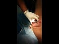 Trabajo de Parto con Circular de cordon irreductible