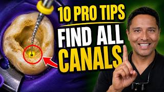 Struggling with Calcified Molars? 10 Endodontic Tips You Need.