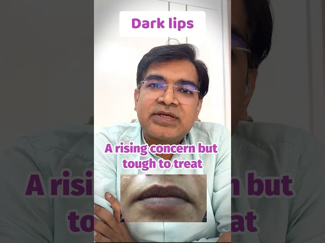 Dark Lips Treatment | काले होंठों का इलाज | Lip Lightening Laser Treatment