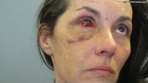 Woman's face shattered after DUI arrest
