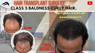 Hair Transplant In Bhopal | Best Cost Results & Surgeon Of Hair Transplant In Bhopal.