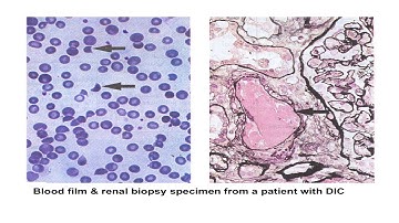 Thrombotic microangiopathies & pregnancy - Prof Beverley Hunt