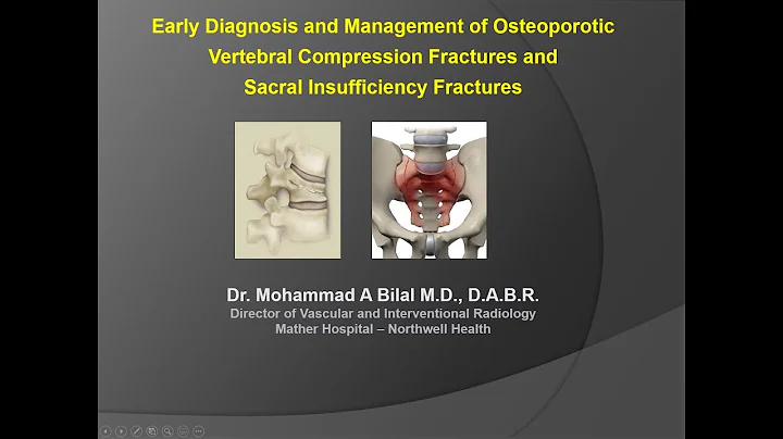 HealthyU webinar series - Kyphoplasty for treating back pain