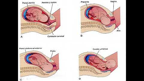 ¿Cuáles son las anomalías de la placenta?