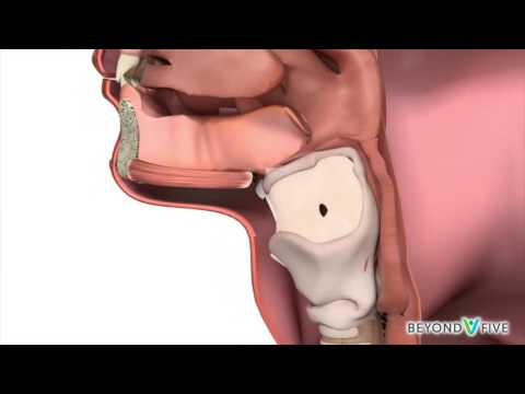 Video: Laryngeal Cancer - Stadier, Symtom, Diagnos, Behandling, Förebyggande