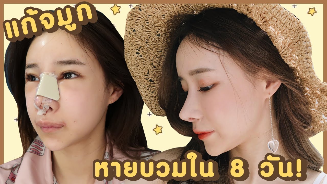 เสริม จมูก สไตล์ เกาหลี  2022 New  VLOG 8 เดือนที่แล้ว : แก้จมูก หายบวมใน 8 วัน ที่ view plastic surgery | ndmikkiholic ♡