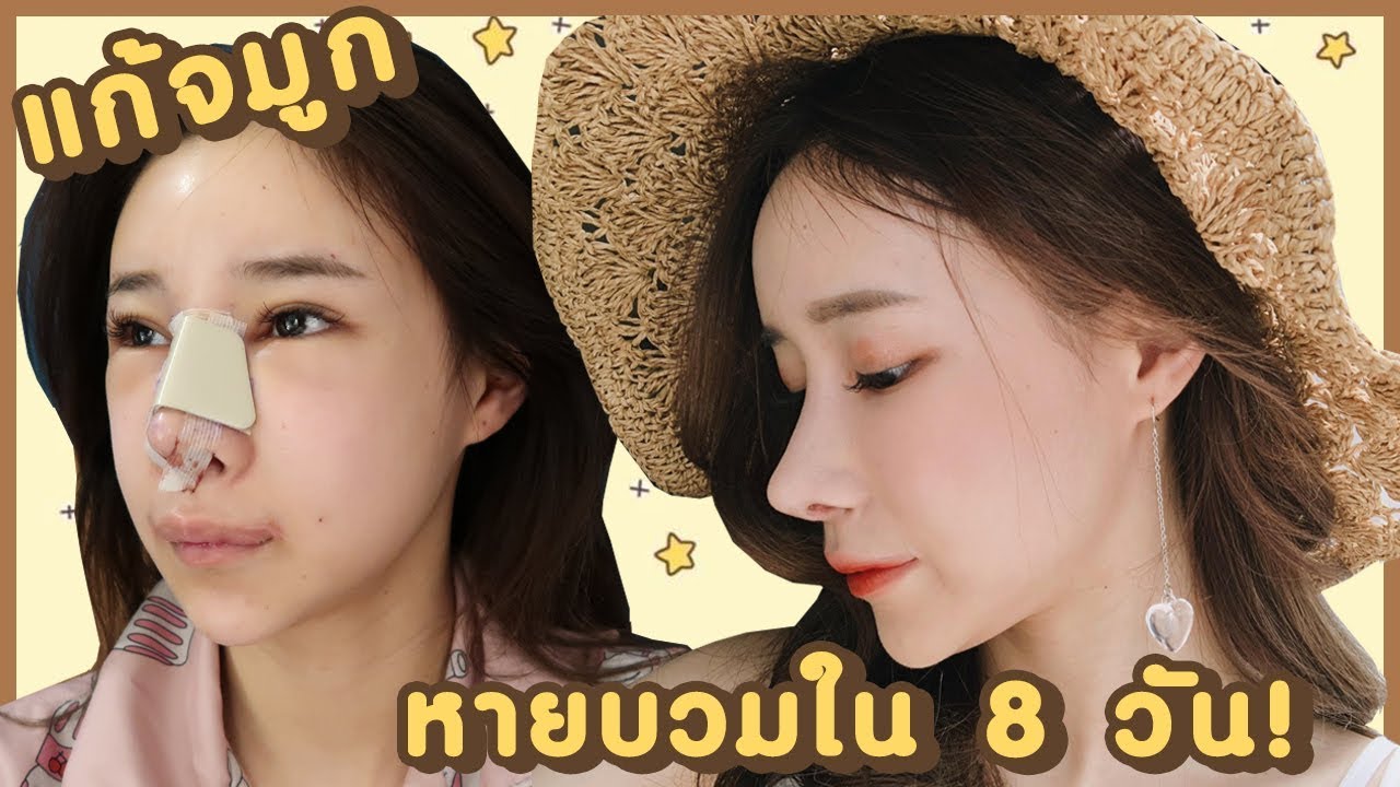 VLOG 8 เดือนที่แล้ว : แก้จมูก หายบวมใน 8 วัน ที่ view plastic surgery | ndmikkiholic ♡