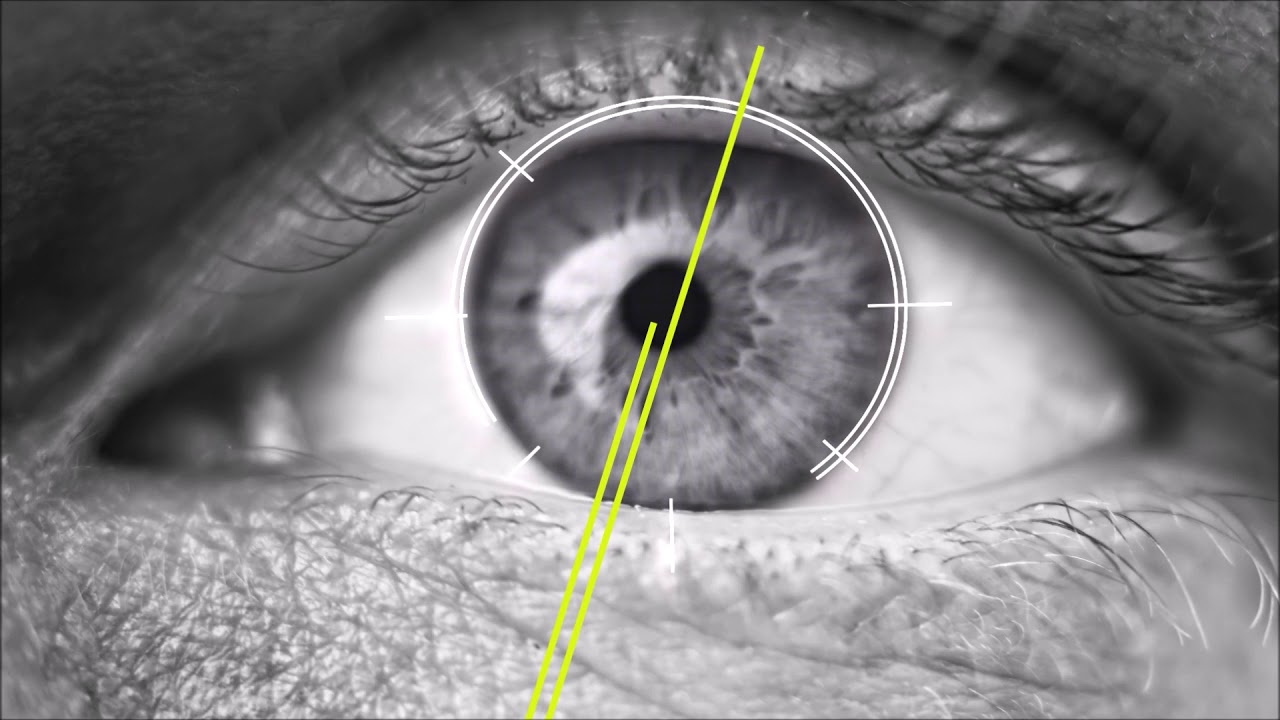 Advanced Astigmatism Treatment in Cataract Surgery YouTube