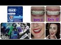 Oral b 3d white whitestrips review  results 