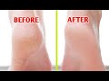 Homemade Foot Cream| Cracked heels home remedy, फटी एड़ियों से छुटकारा पाएं ,