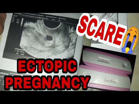 Video: Magpapakita ba ang isang ectopic na pagbubuntis sa isang pagsubok sa pagbubuntis?