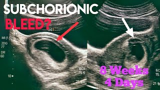 Bleeding in Early Pregnancy | Subchorionic Hemorrhage | Threatened Miscarriage | Ultrasound study