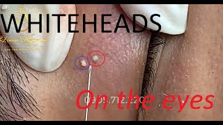 #27 #whiteheads and pimples hidden under the skin