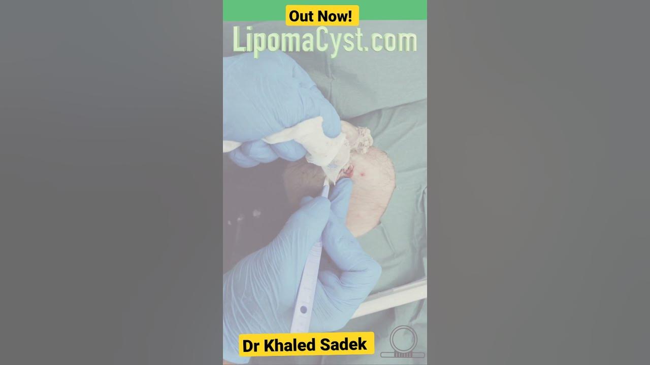 Biggest Cyst EVER. Dr Khaled Sadek cystremoval YouTube
