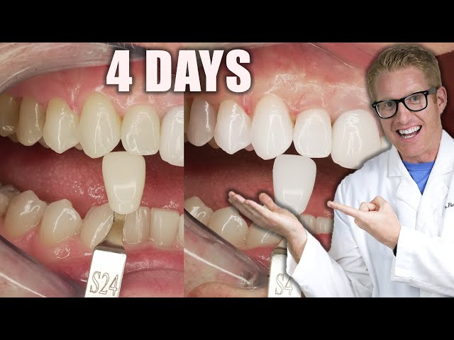 Dentist PROVES The BEST TEETH WHITENING Results Are AT HOME (Not