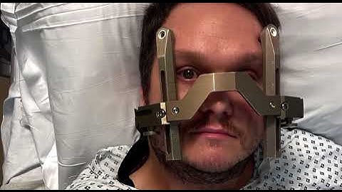 AVM treatment  - Gamma Knife Radiosurgery