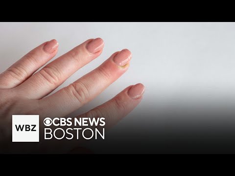 What is a paronychia and how can it be treated?