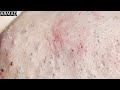 🤯 MOST SATISFYING BLACKHEAD EXTRACTION EVER!