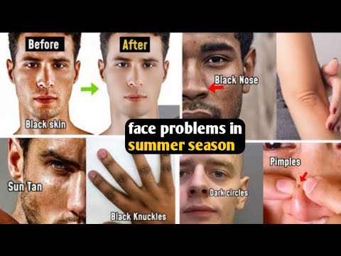 face problem in summer season - YouTube