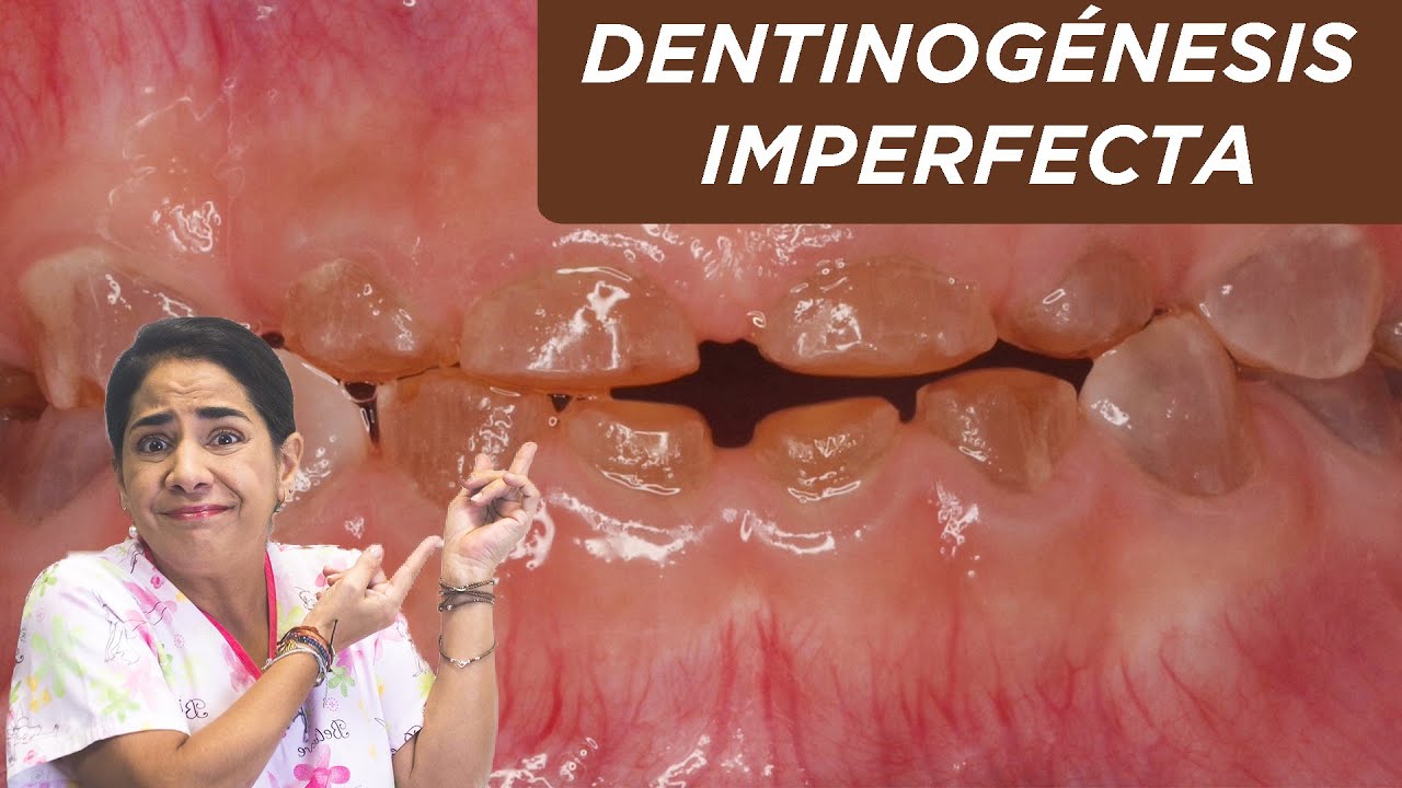 Dentinogénesis imperfecta: ¿qué es? ¿por qué sucede?