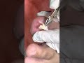 Ep_4143 *Big ingrown toenail removal 👣 ไม่คาดคิดว่าจะขนาดนี้ 😁 (clip from Thailand)