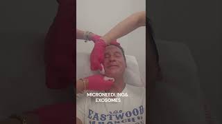 Deep and Bloody #microneedling and #clinical grade #exosomes