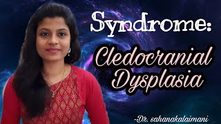 Explained Easily: Syndromes- Cleidocranial Dysplasia
