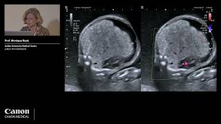 ISUOG 2022 - Prof. Monique Haak - Ultrasound for the diagnosis and treatment of intrathoracic tumors