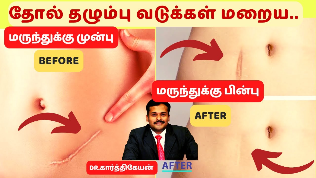 தோல் வடுக்கள் தழும்புகள் மறைய 6 டாக்டர் டிப்ஸ்|6 skin scar removal treatment in tamil|dr karthikeyan
