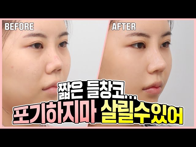 [코재수술 리뷰] 짧은 들창코..자려한코로 살리기 | 에이비성형외과