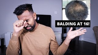 How To Deal With Balding As a Teen! (Mindset/Treatments/Grooming)