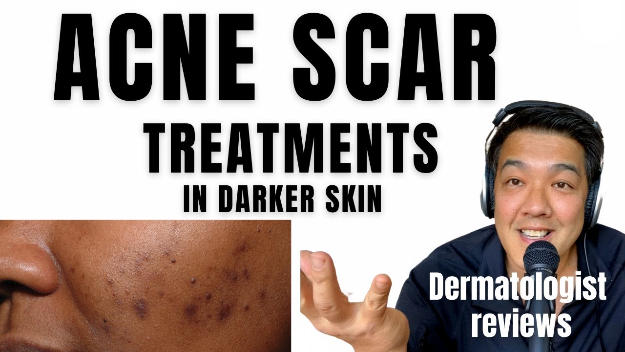 ACNE SCAR TREATMENTS In Ethnic Skin YouTube