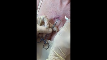 remove a running suture video by Dr David Buckey www.kerryskinclinic.ie