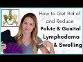 How to Get Rid of Pelvic or Genital Swelling- Treatment Options for Lymphedema