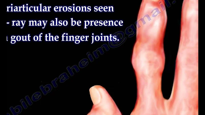 Arthritis Of The Fingers types and patterns - Everything You Need To Know - Dr. Nabil Ebraheim