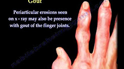 Arthritis Of The Fingers types and patterns - Everything You Need To Know - Dr. Nabil Ebraheim