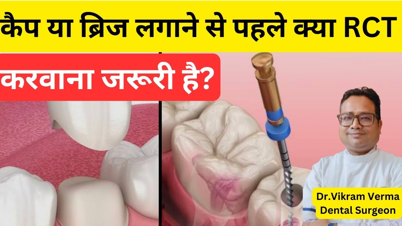 Cap/Bridge लगाने से पहले RCT करना ज़रूरी है क्या?|Is RCT Necessary For ...
