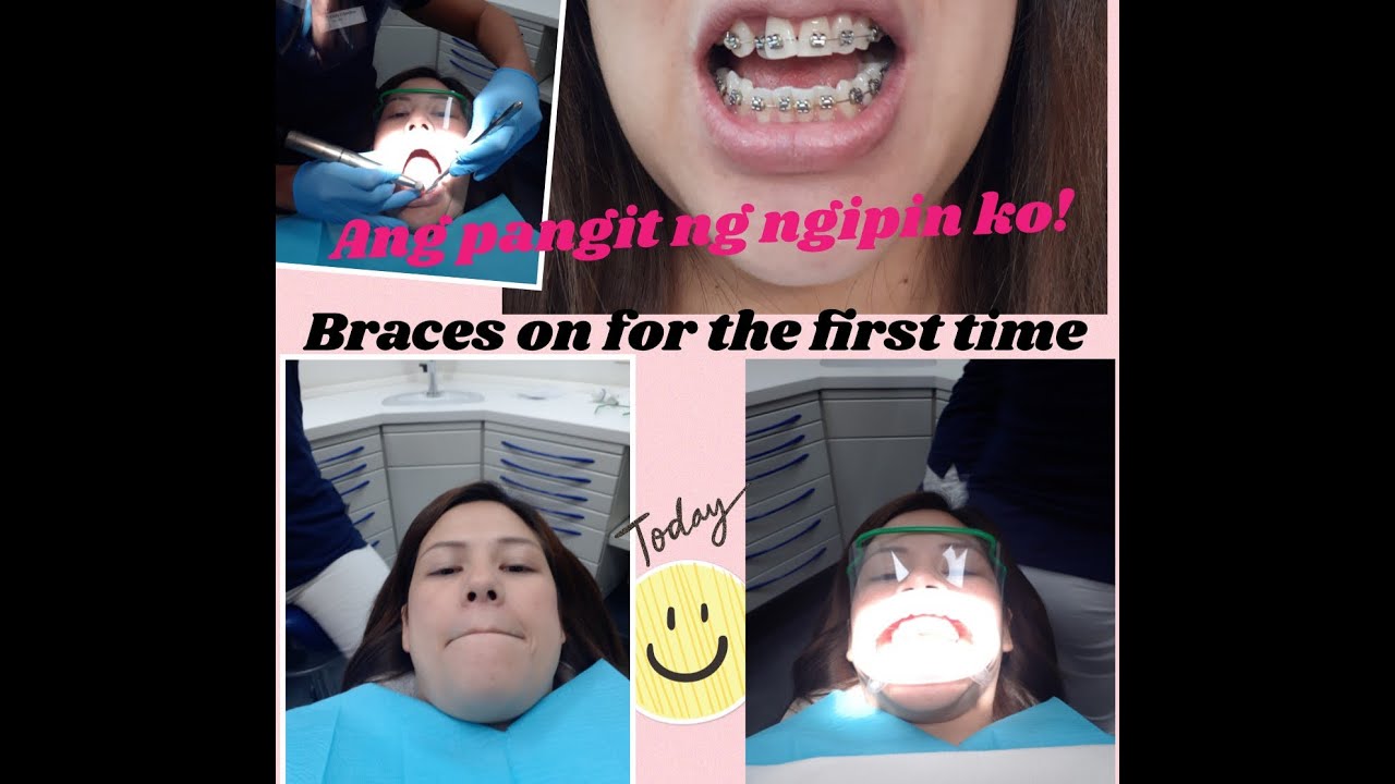 Braces on for the first time The Netherlands YouTube
