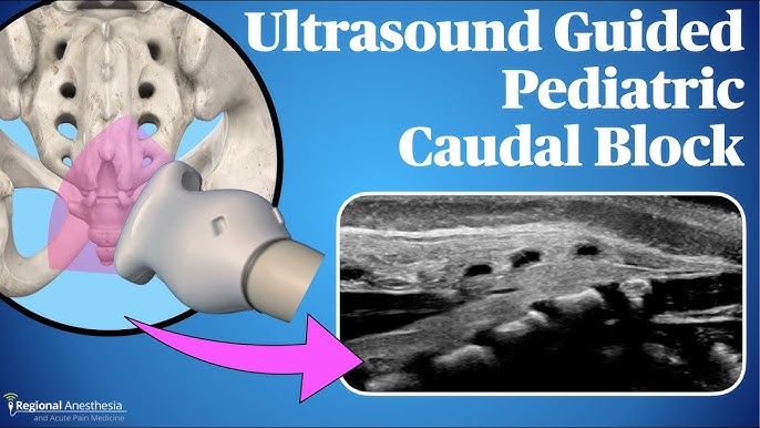 RAPTIR Block 5MS (2021) - Core Ultrasound